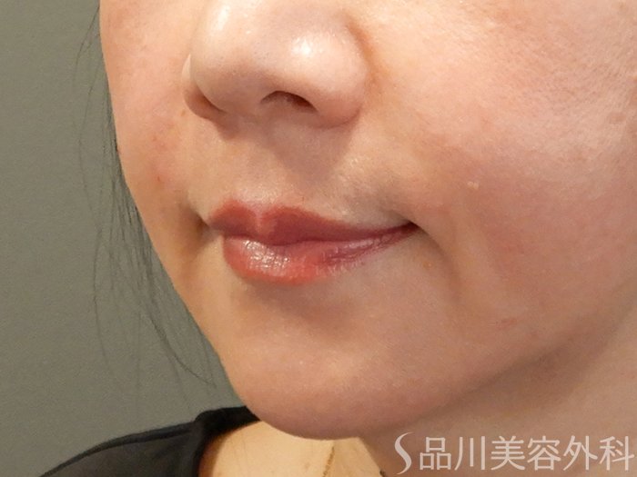 症例NO.70923のAFTER写真