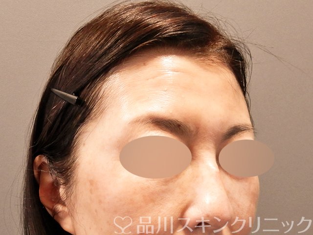 症例NO.71084のBEFORE写真
