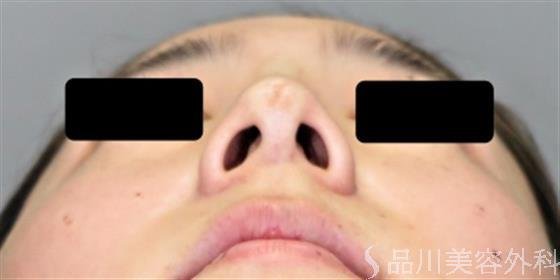 症例NO.46907のAFTER写真