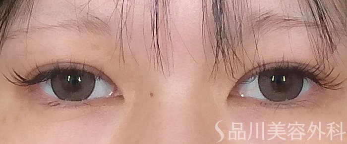 症例NO.67646のAFTER写真