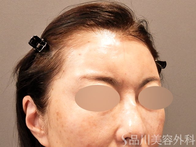 症例NO.71084のAFTER写真
