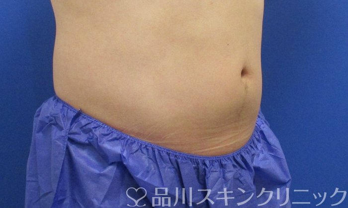 症例NO.70460のAFTER写真