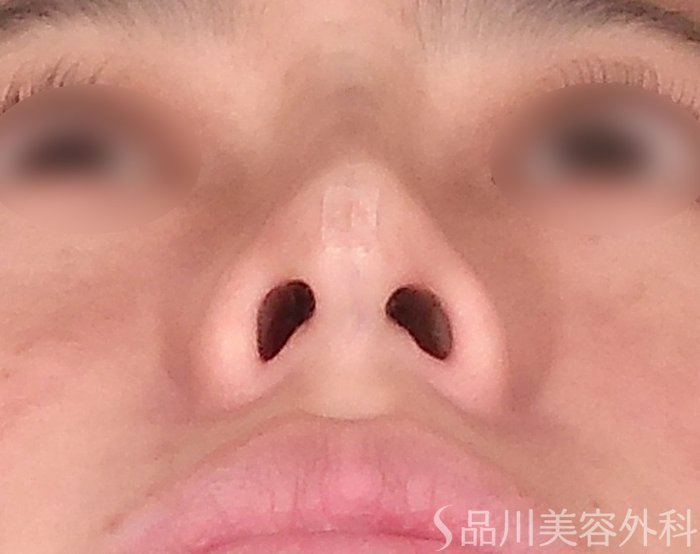 症例NO.69811のAFTER写真