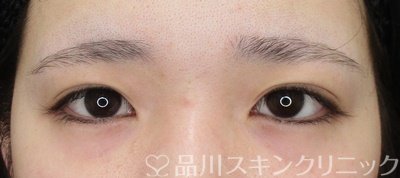 症例NO.69303のBEFORE写真