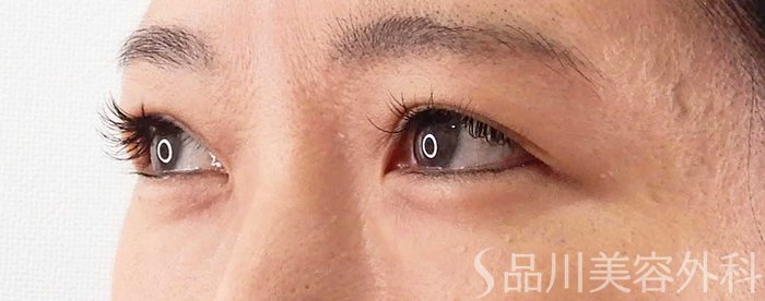 症例NO.67862のBEFORE写真
