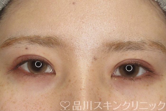 症例NO.69211のAFTER写真
