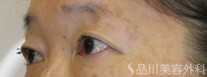 症例NO.70828のBEFORE写真