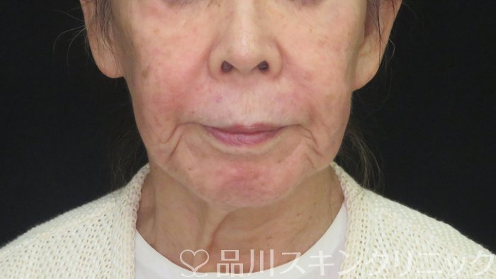 症例NO.72288のBEFORE写真