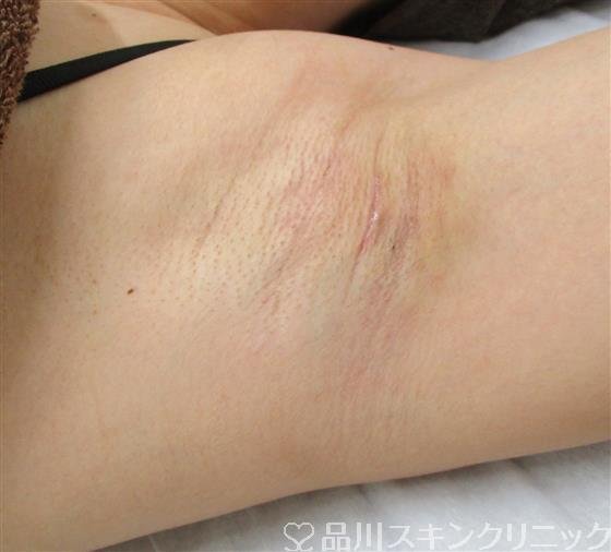 症例NO.42155のAFTER写真