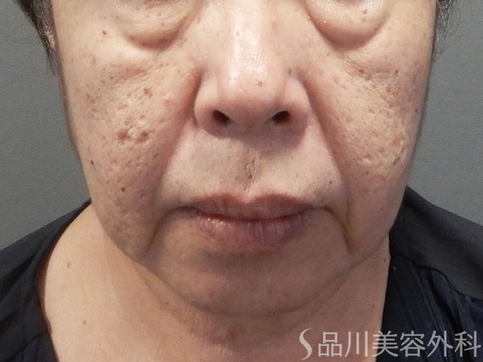 症例NO.70857のBEFORE写真