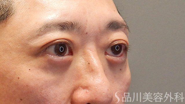 症例NO.74560のAFTER写真