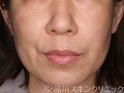 症例NO.71753のBEFORE写真