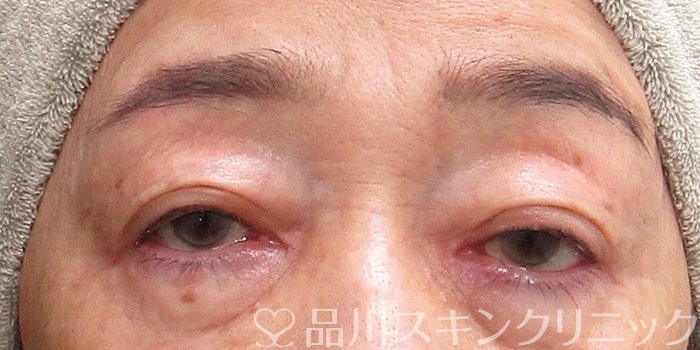 症例NO.75150のAFTER写真