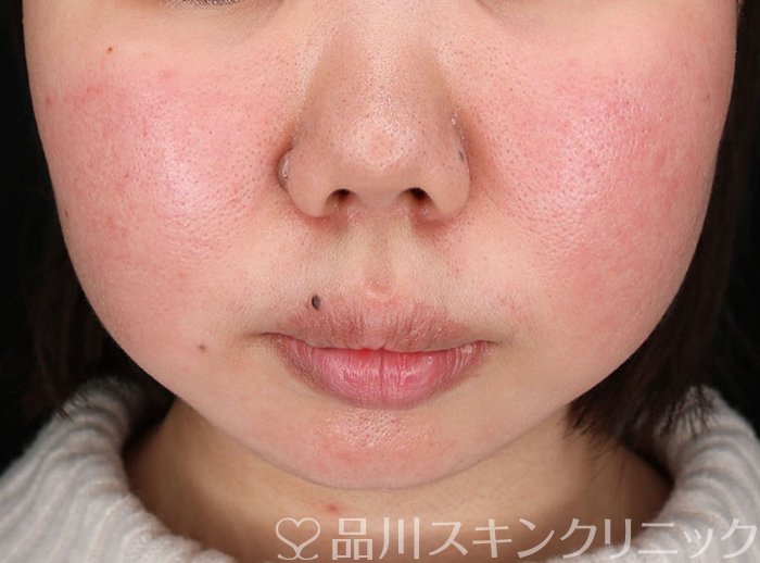 症例NO.63949のBEFORE写真