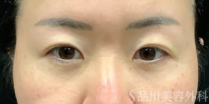 症例NO.71247のBEFORE写真