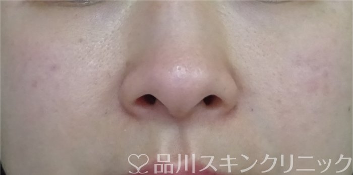 症例NO.69327のAFTER写真