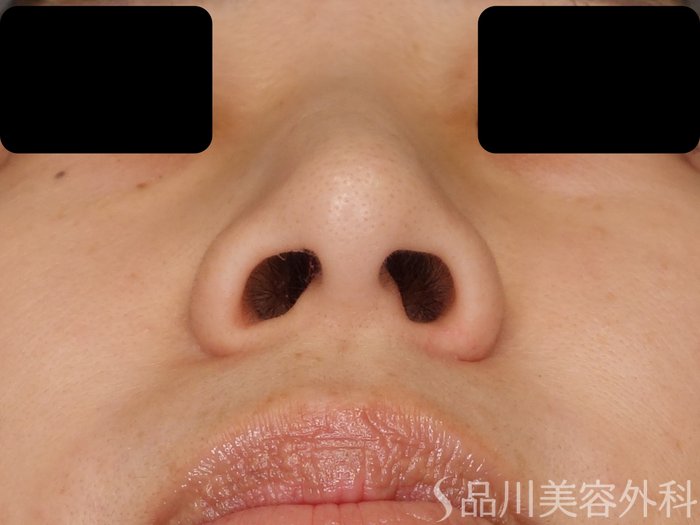 症例NO.62247のBEFORE写真