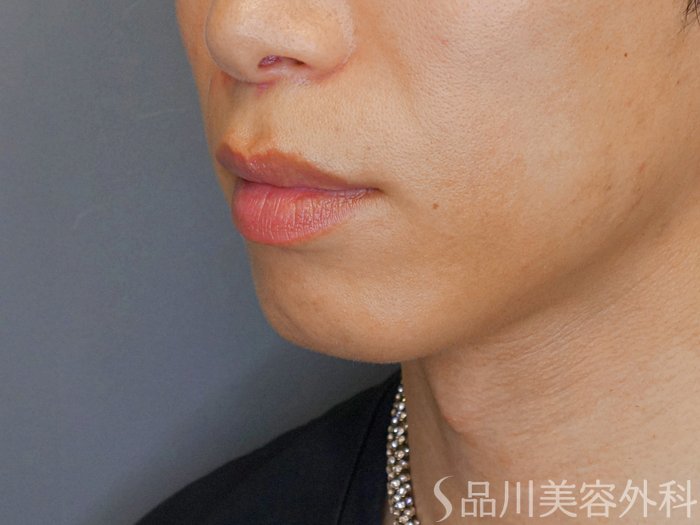 症例NO.70881のBEFORE写真