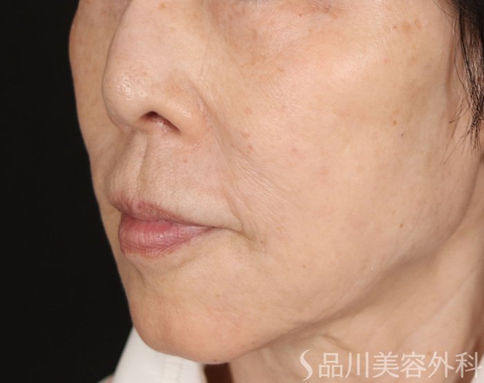 症例NO.71681のBEFORE写真