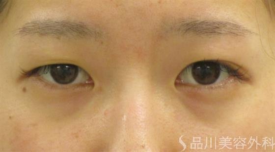 症例NO.47260のBEFORE写真