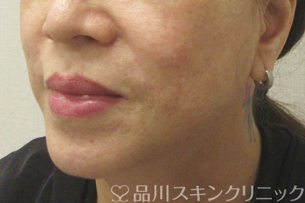 症例NO.75224のAFTER写真
