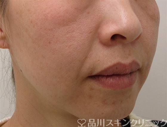 症例NO.53322のBEFORE写真