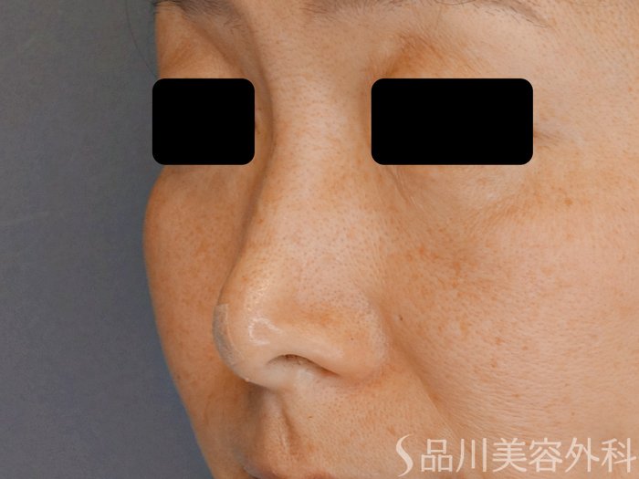 症例NO.71408のAFTER写真