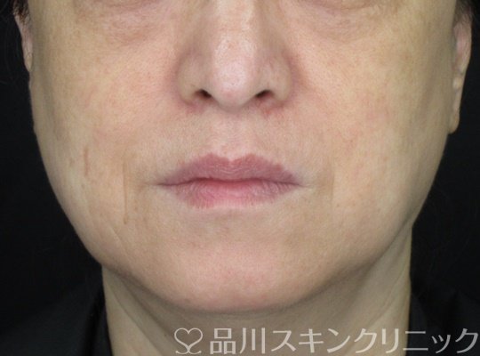 症例NO.69311のBEFORE写真