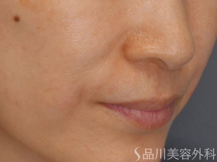 症例NO.71860のAFTER写真