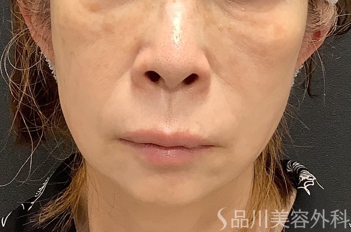 症例NO.75048のAFTER写真