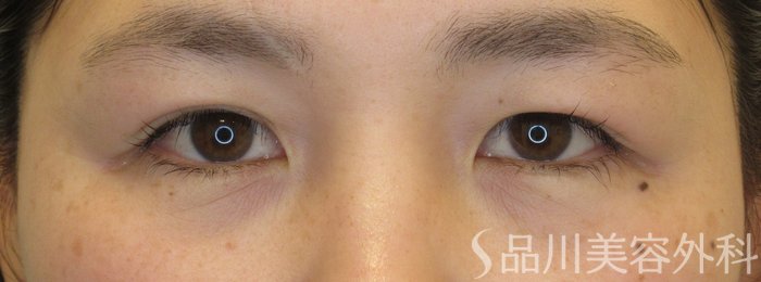 症例NO.71690のBEFORE写真