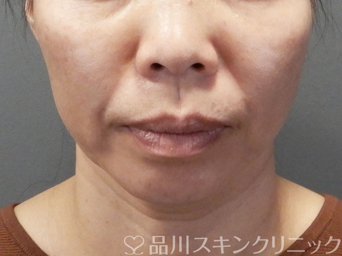 症例NO.73479のBEFORE写真