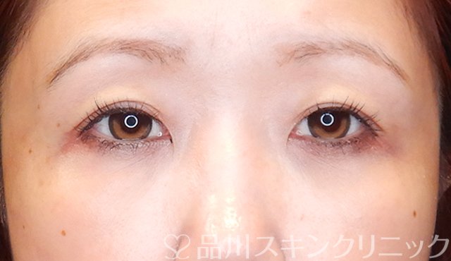 症例NO.75350のAFTER写真