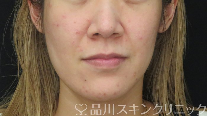 症例NO.72544のBEFORE写真