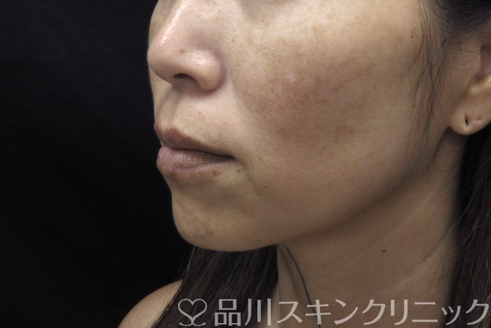 症例NO.74639のBEFORE写真