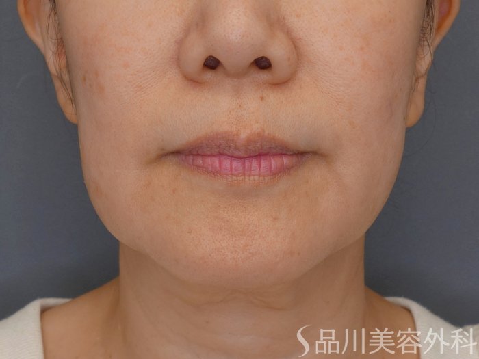 症例NO.70864のBEFORE写真