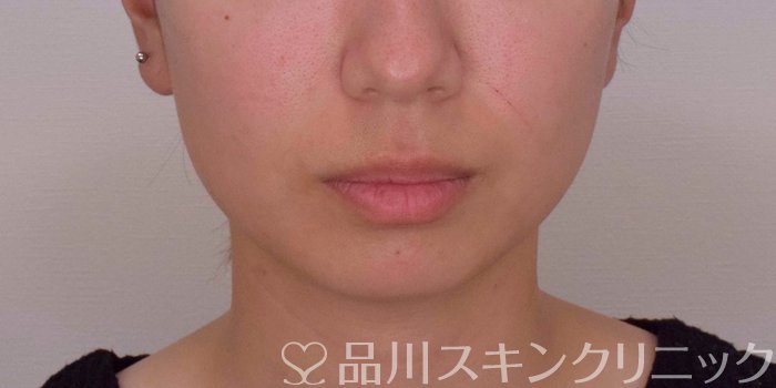 症例NO.67764のBEFORE写真