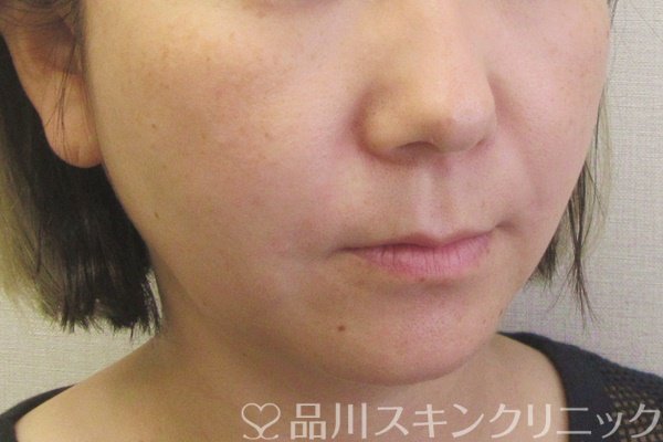 症例NO.70410のAFTER写真