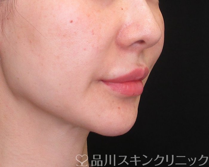 症例NO.75266のBEFORE写真