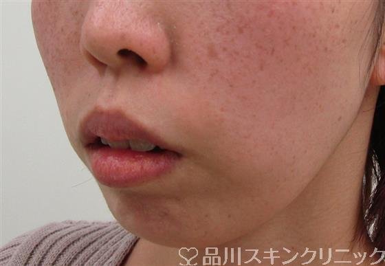 症例NO.34452のBEFORE写真