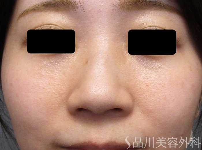 症例NO.74892のBEFORE写真