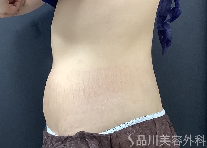 症例NO.75368のAFTER写真