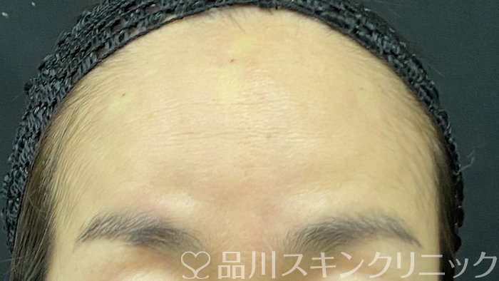 症例NO.74854のAFTER写真