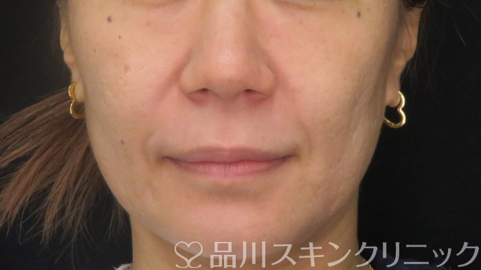 症例NO.71121のAFTER写真