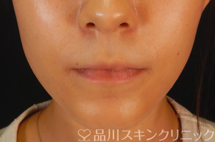 症例NO.66676のBEFORE写真