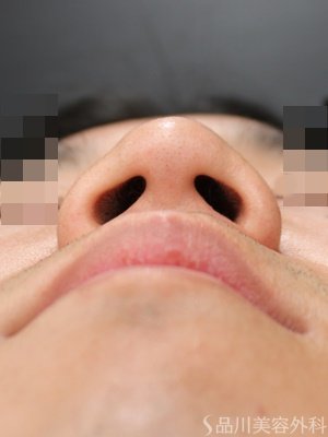 症例NO.70034のBEFORE写真