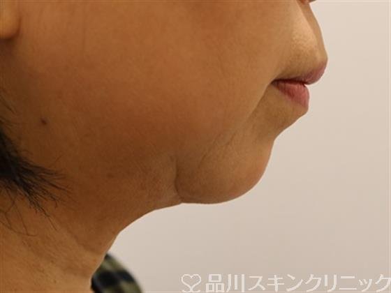 症例NO.43835のBEFORE写真