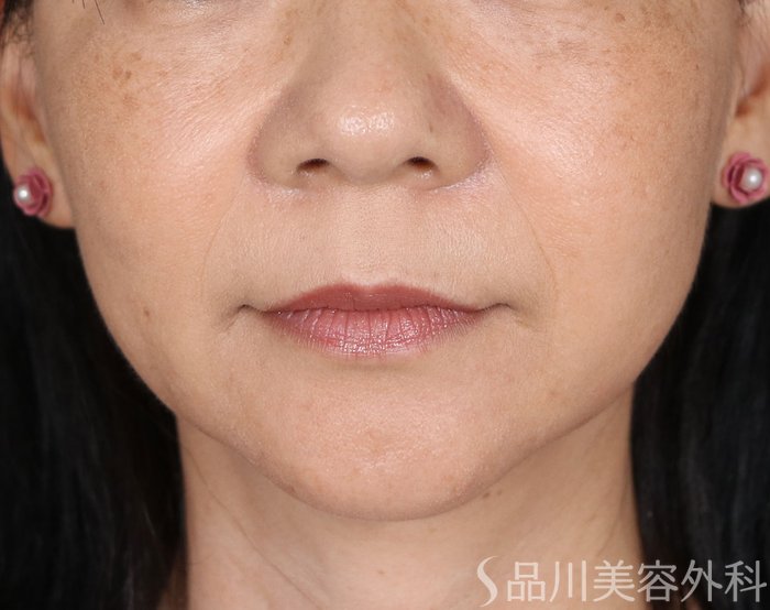 症例NO.72076のAFTER写真