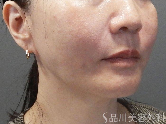 症例NO.72530のAFTER写真