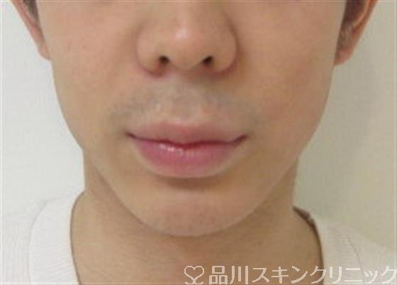 症例NO.34424のBEFORE写真